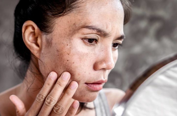 Soin de la peau : Toutes nos astuces qui sont les plus efficaces pour vous débarrasser des tâches brunes !