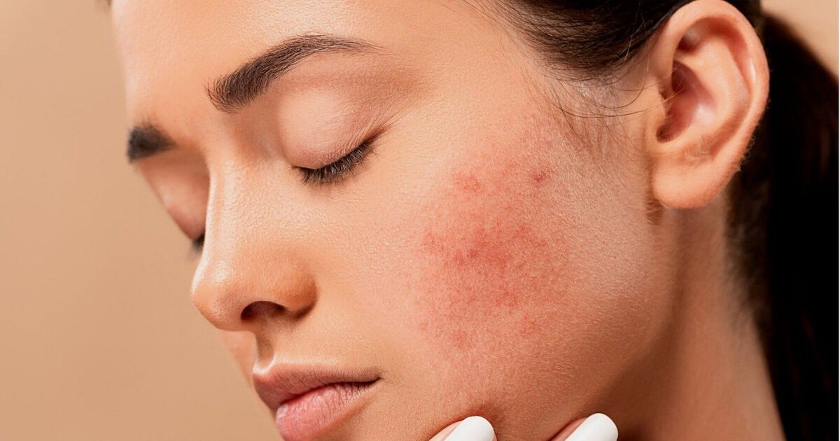 Beauté : Les 3 erreurs majeures que font absolument toutes les femmes qui ont de l’acné !