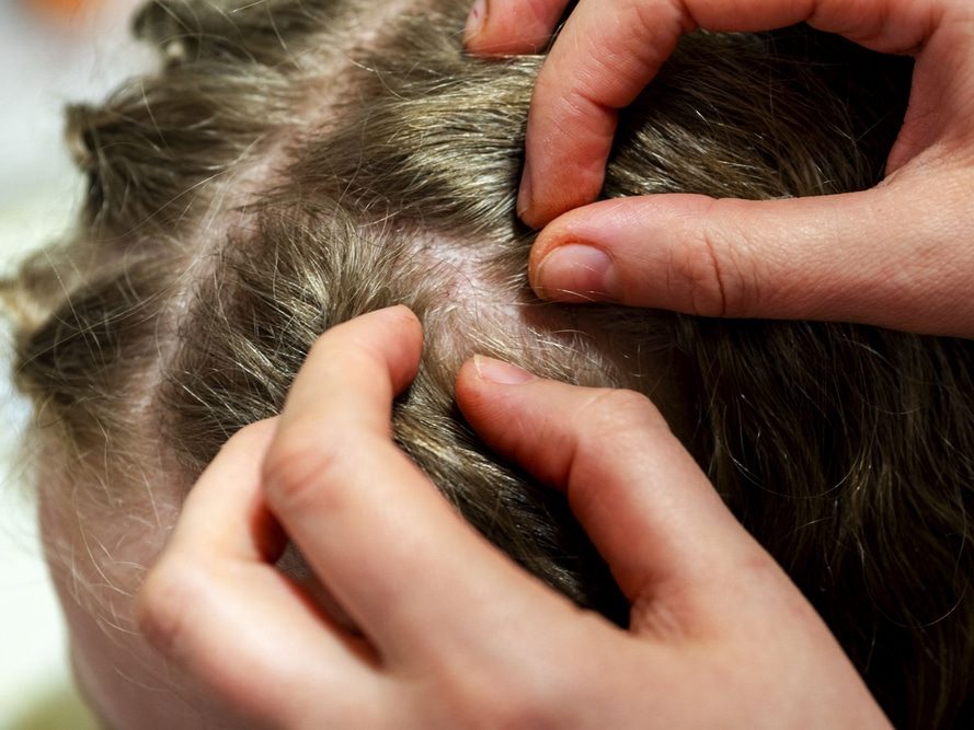 Poux dans les cheveux
